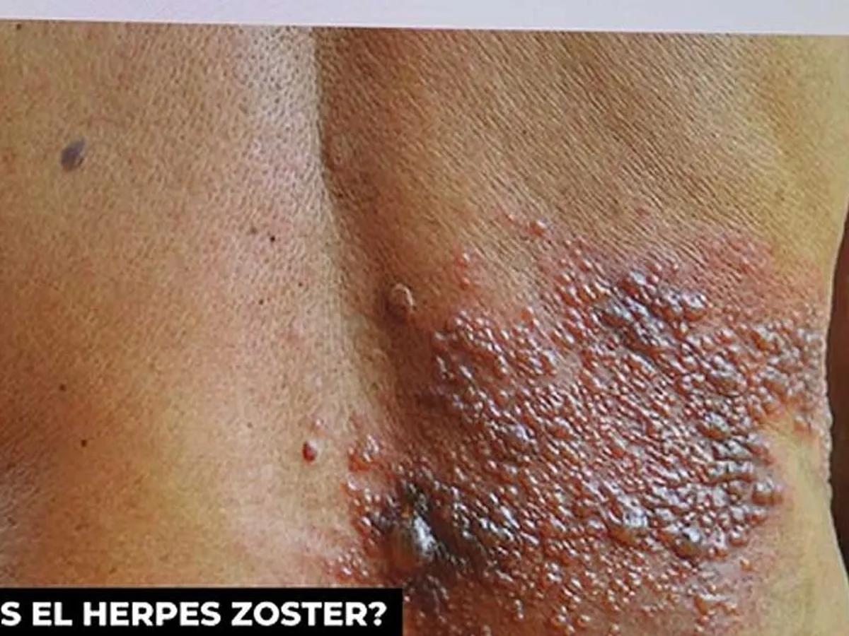 herpes zóster de mudanza - Qué tipo de aislamiento requiere el herpes zóster